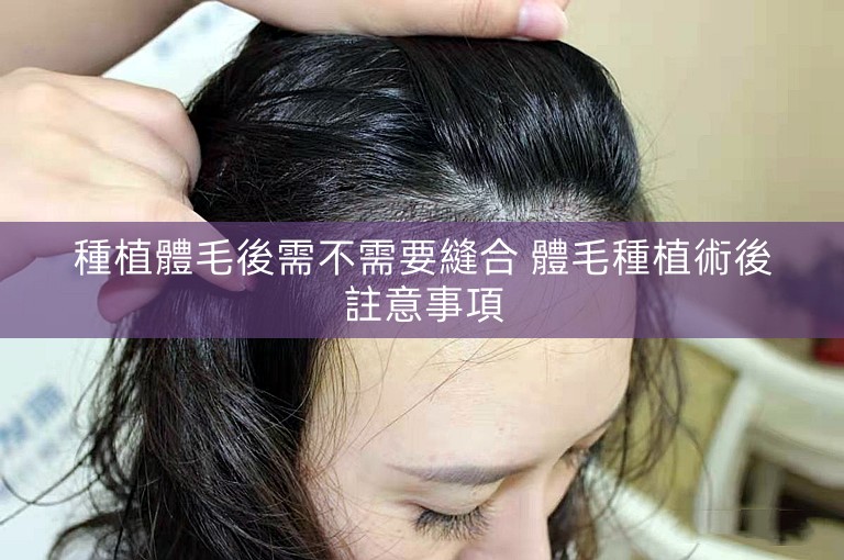 種植體毛後需不需要縫合 體毛種植術後註意事項 種植體毛後需不需要縫合 體毛種植術後註意事項