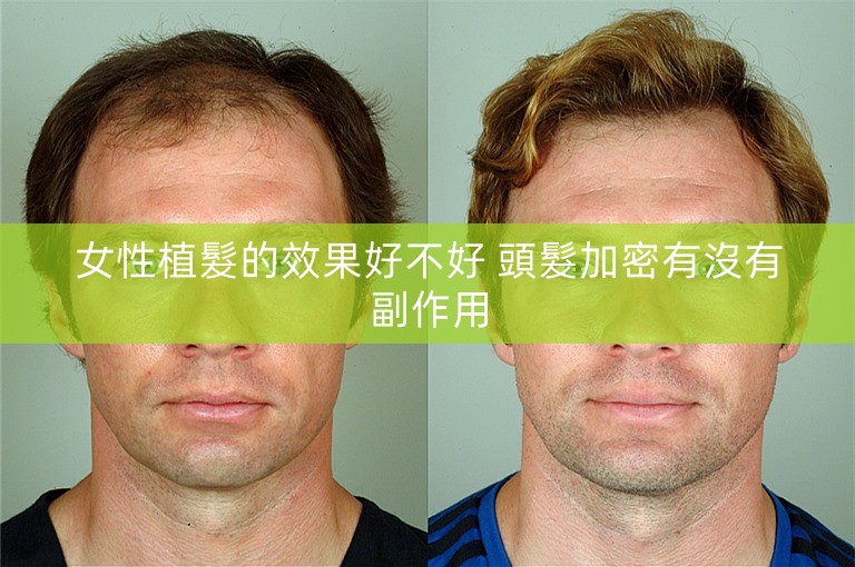 女性植髮的效果好不好 頭髮加密有沒有副作用