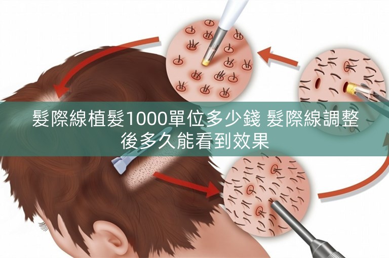 髮際線植髮1000單位多少錢 髮際線調整後多久能看到效果