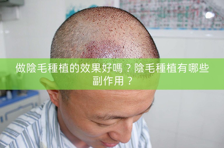 做陰毛種植的效果好嗎?陰毛種植有哪些副作用? 做陰毛種植的效果好嗎?陰毛種植有哪些副作用?