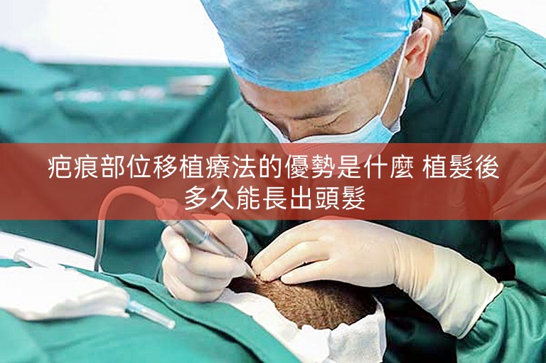 疤痕部位移植療法的優勢是什麼 植髮後多久能長出頭髮