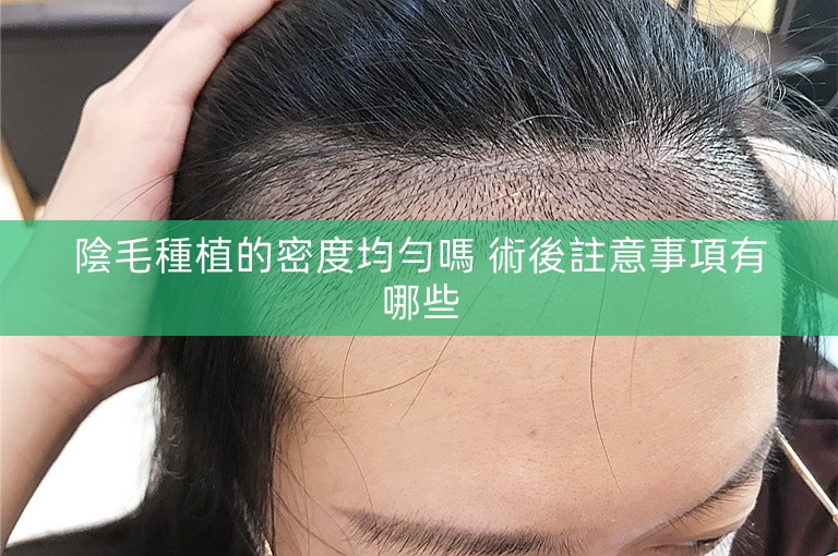 陰毛種植的密度均勻嗎 術後註意事項有哪些