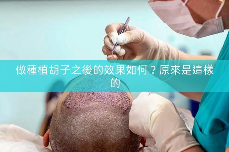 做種植胡子之後的效果如何?原來是這樣的 做種植胡子之後的效果如何?原來是這樣的