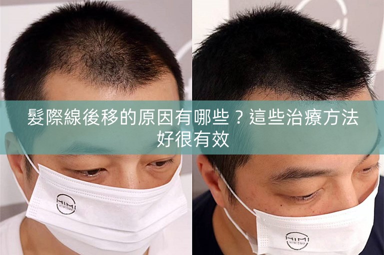 髮際線後移的原因有哪些?這些治療方法好很有效 髮際線後移的原因有哪些?這些治療方法好很有效