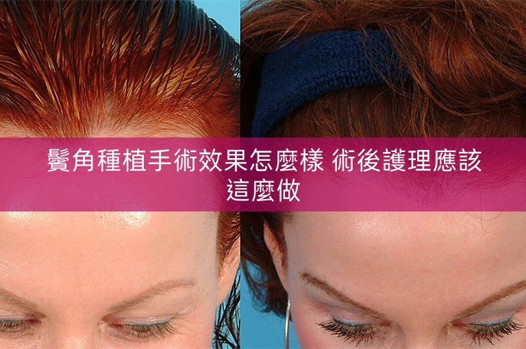 鬢角種植手術效果怎麼樣 術後護理應該這麼做