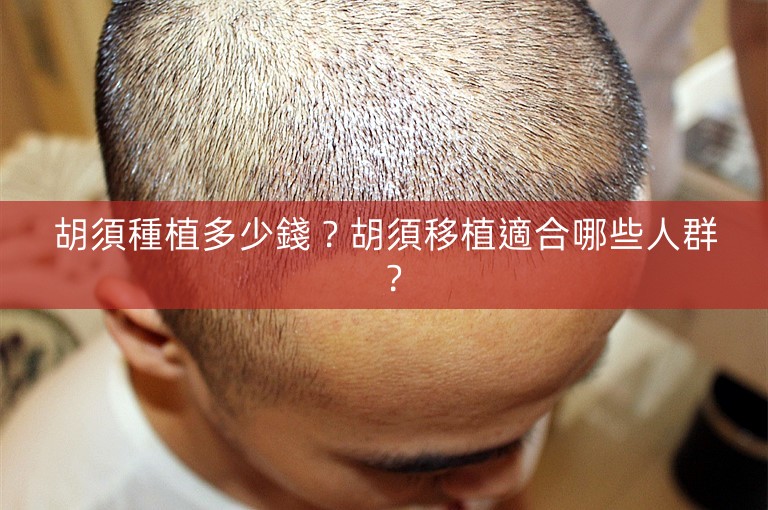 胡須種植多少錢?胡須移植適合哪些人群? 胡須種植多少錢?胡須移植適合哪些人群?