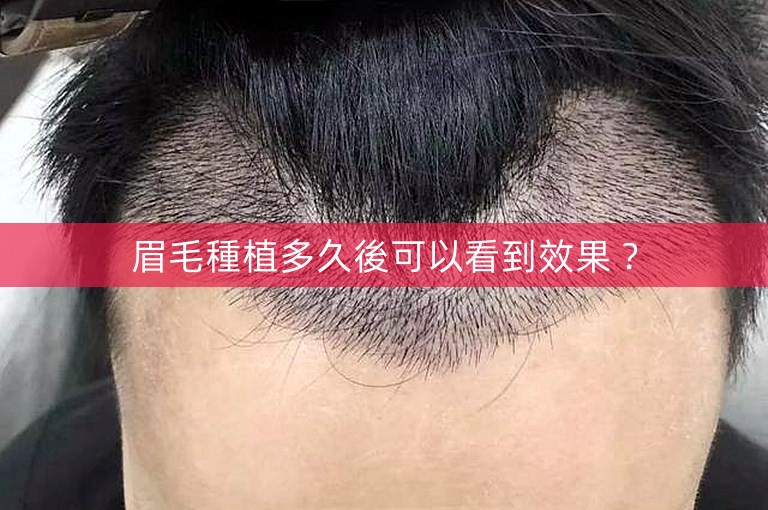 眉毛種植多久後可以看到效果？