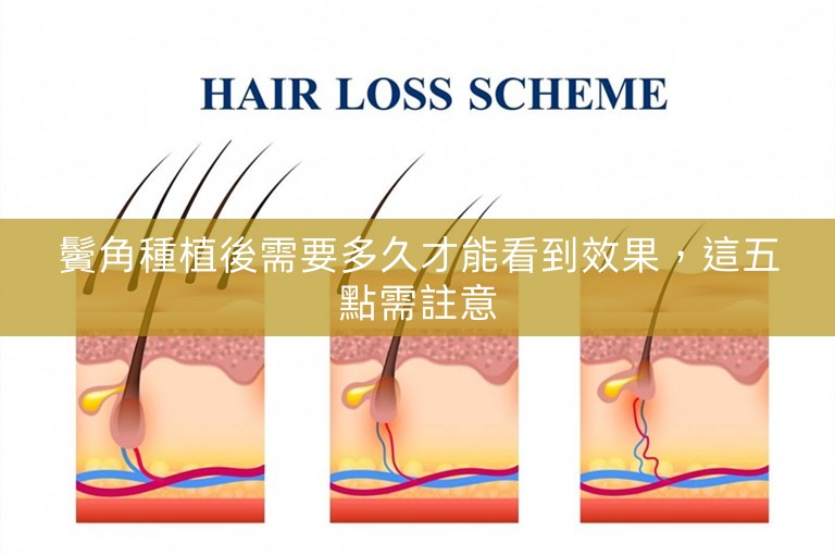 鬢角種植後需要多久才能看到效果，這五點需註意