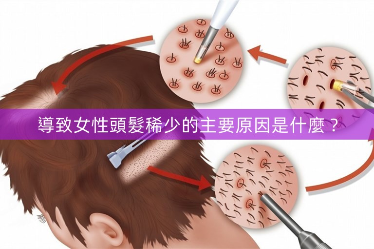 導致女性頭髮稀少的主要原因是什麼？