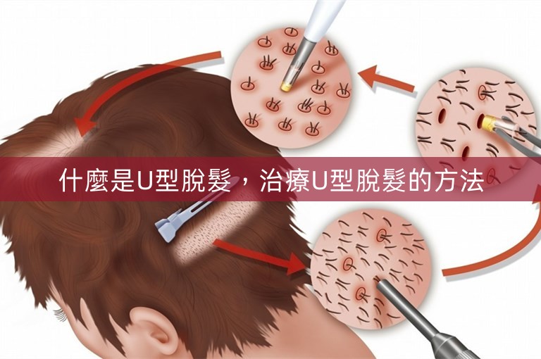 什麼是U型脫髮，治療U型脫髮的方法