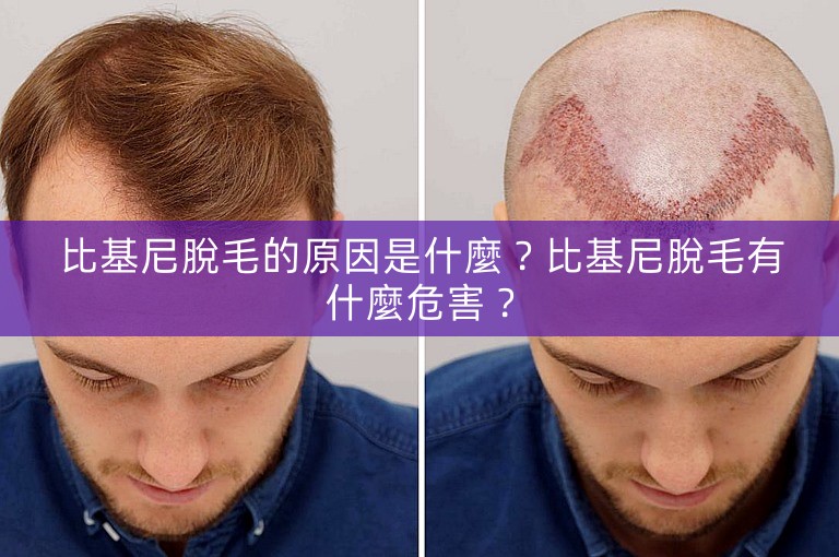 比基尼脫毛的原因是什麼？比基尼脫毛有什麼危害？