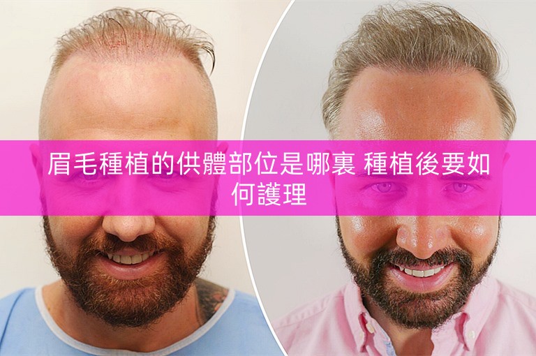 眉毛種植的供體部位是哪裏 種植後要如何護理
