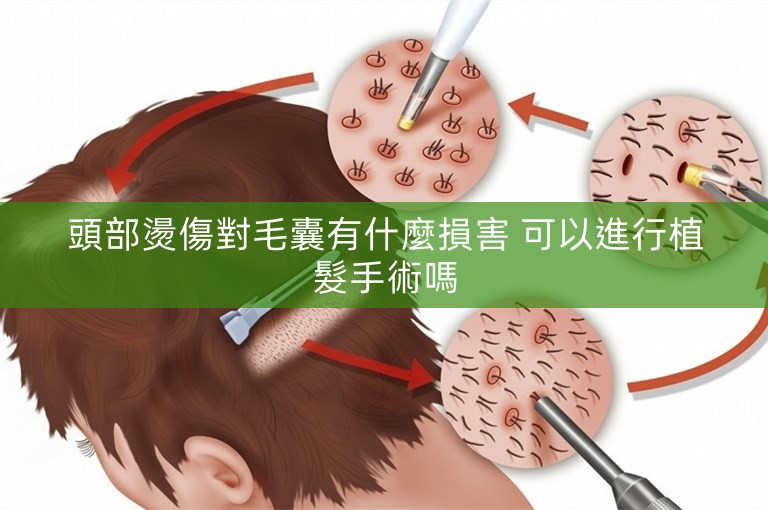 頭部燙傷對毛囊有什麼損害 可以進行植髮手術嗎