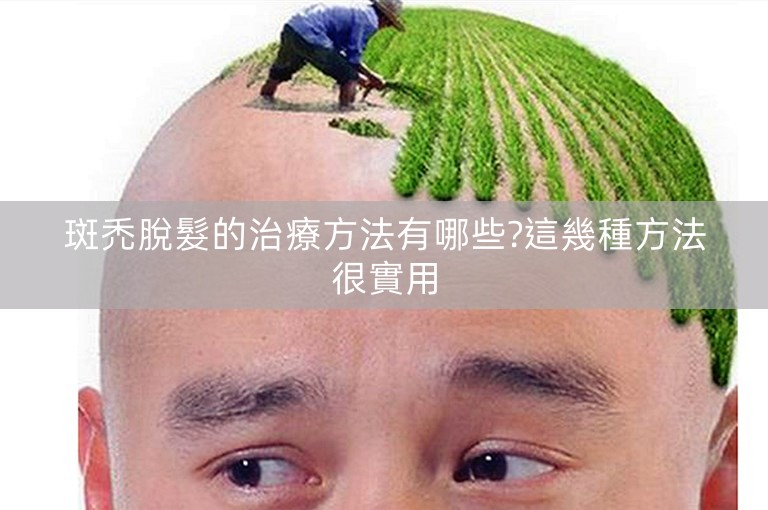 斑禿脫髮的治療方法有哪些?這幾種方法很實用