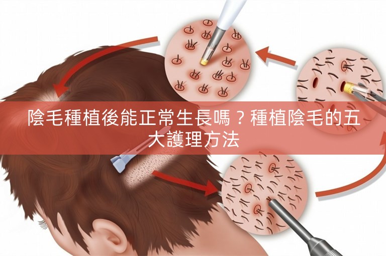 陰毛種植後能正常生長嗎？種植陰毛的五大護理方法