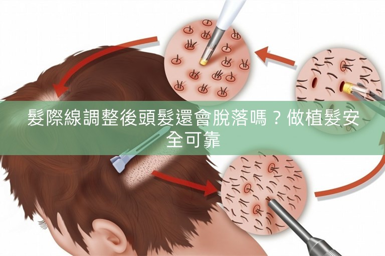 髮際線調整後頭髮還會脫落嗎？做植髮安全可靠