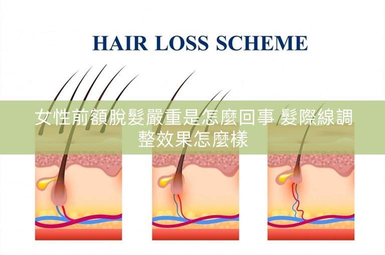 女性前額脫髮嚴重是怎麼回事 髮際線調整效果怎麼樣