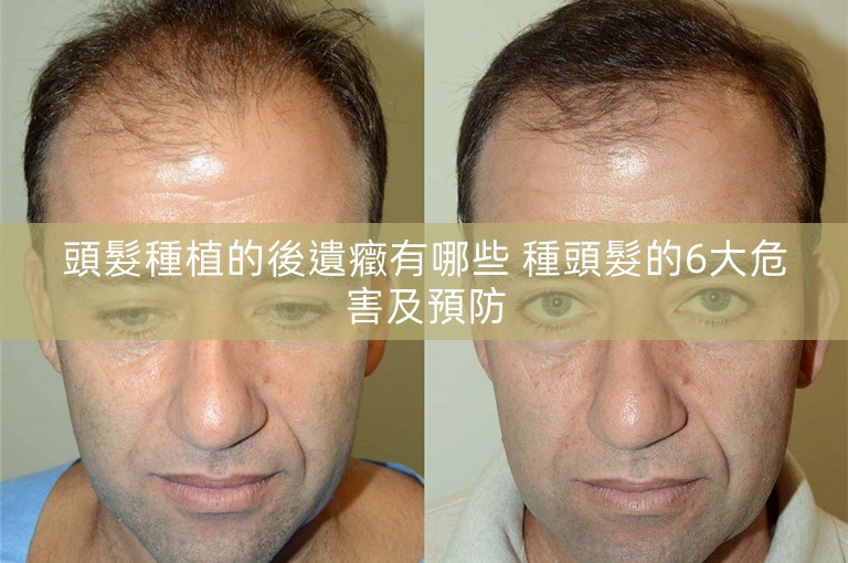 頭髮種植的後遺癥有哪些 種頭髮的6大危害及預防