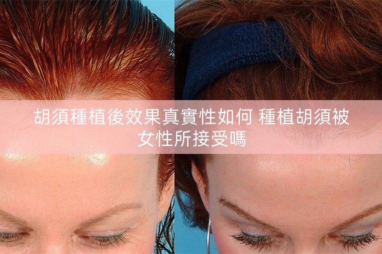 胡須種植後效果真實性如何 種植胡須被女性所接受嗎