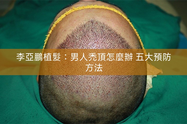 李亞鵬植髮:男人禿頂怎麼辦 五大預防方法 李亞鵬植髮:男人禿頂怎麼辦 五大預防方法