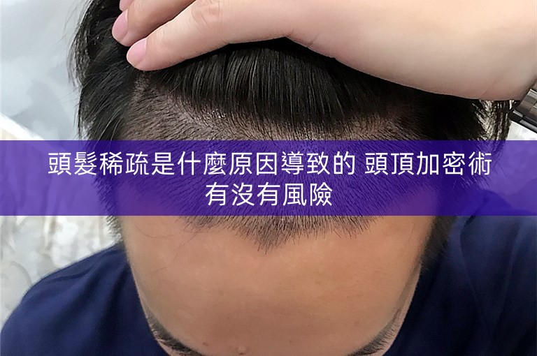 頭髮稀疏是什麼原因導致的 頭頂加密術有沒有風險