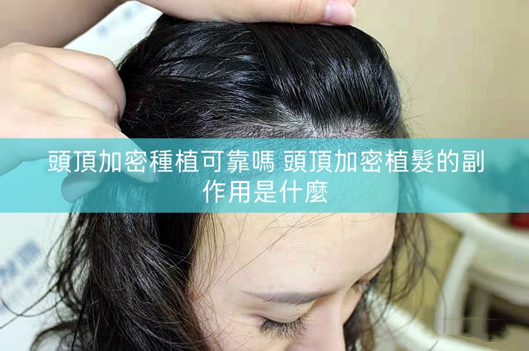 頭頂加密種植可靠嗎 頭頂加密植髮的副作用是什麼 頭頂加密種植可靠嗎 頭頂加密植髮的副作用是什麼