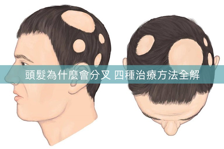 頭髮為什麼會分叉 四種治療方法全解