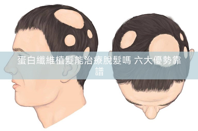 蛋白纖維植髮能治療脫髮嗎 六大優勢靠譜