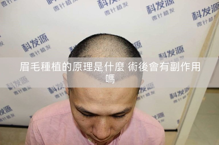 眉毛種植的原理是什麼 術後會有副作用嗎