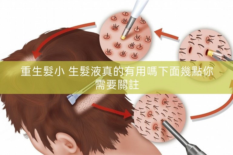 重生髮小 生髮液真的有用嗎下面幾點你需要關註