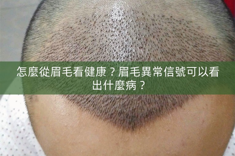 怎麼從眉毛看健康？眉毛異常信號可以看出什麼病？