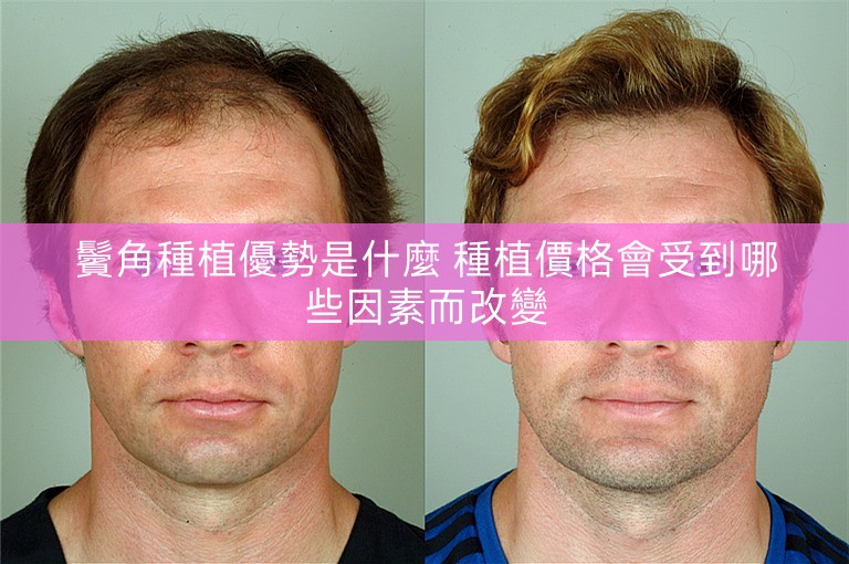 鬢角種植優勢是什麼 種植價格會受到哪些因素而改變