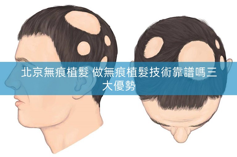 北京無痕植髮 做無痕植髮技術靠譜嗎三大優勢