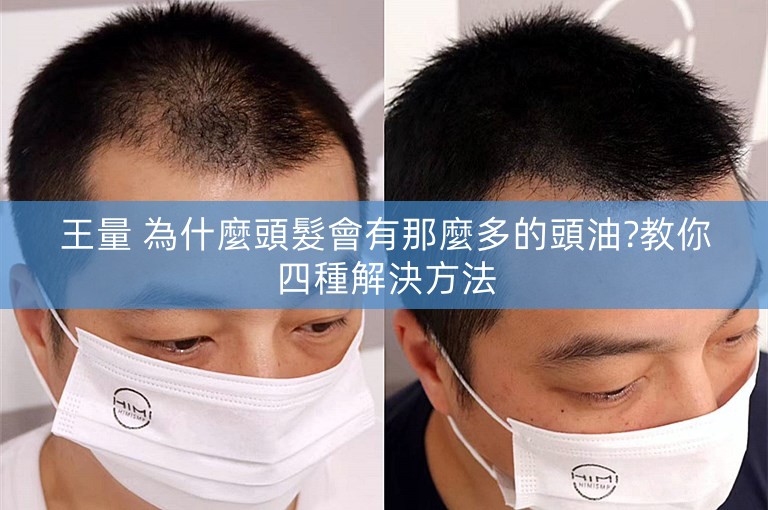 王量 為什麼頭髮會有那麼多的頭油?教你四種解決方法