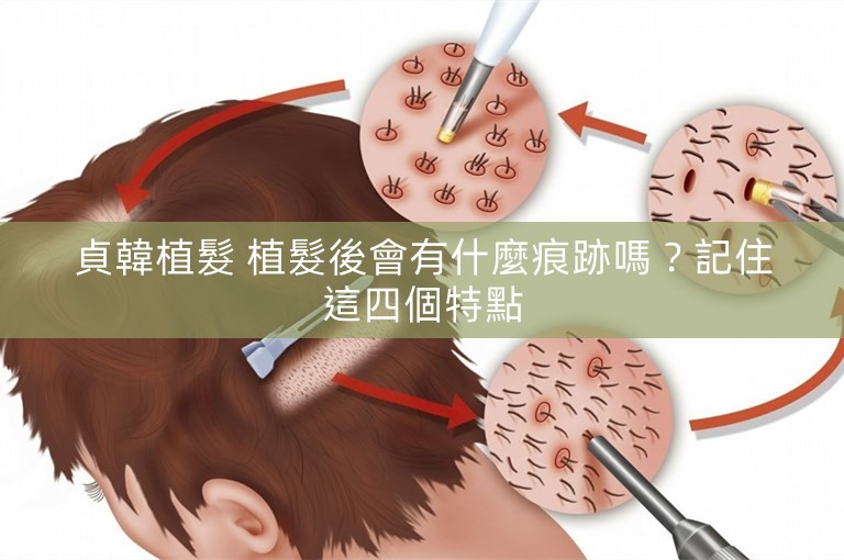 貞韓植髮 植髮後會有什麼痕跡嗎？記住這四個特點