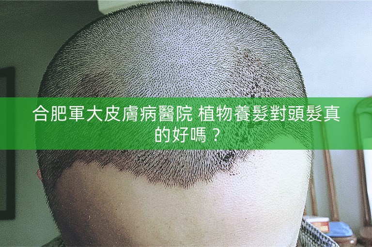 合肥軍大皮膚病醫院 植物養髮對頭髮真的好嗎？