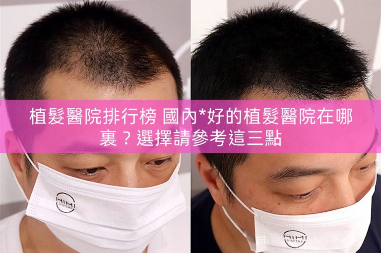植髮醫院排行榜 國內*好的植髮醫院在哪裏？選擇請參考這三點
