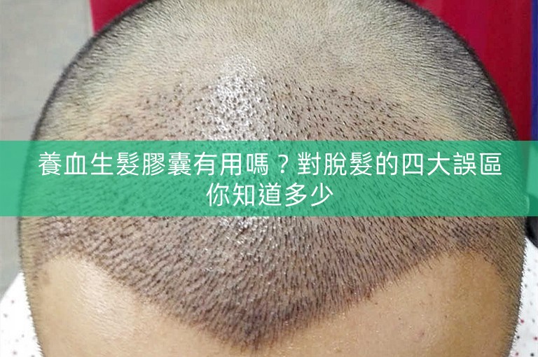 養血生髮膠囊有用嗎？對脫髮的四大誤區你知道多少
