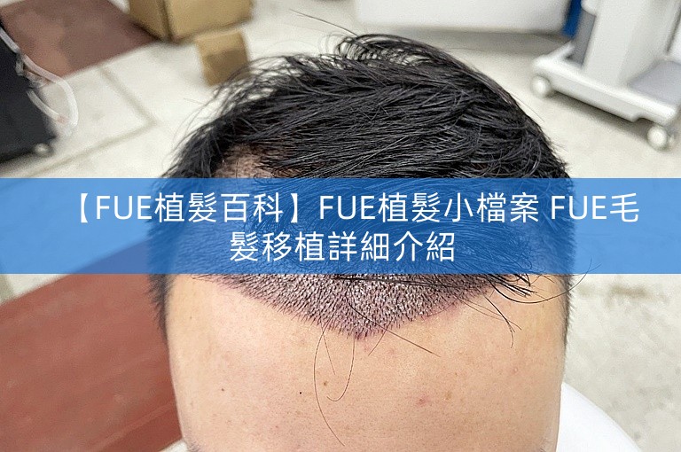 【FUE植髮百科】FUE植髮小檔案 FUE毛髮移植詳細介紹