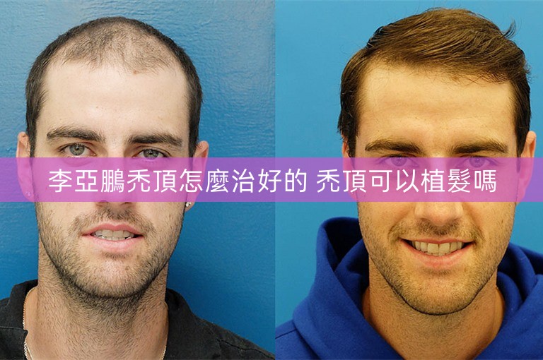李亞鵬禿頂怎麼治好的 禿頂可以植髮嗎 李亞鵬禿頂怎麼治好的 禿頂可以植髮嗎
