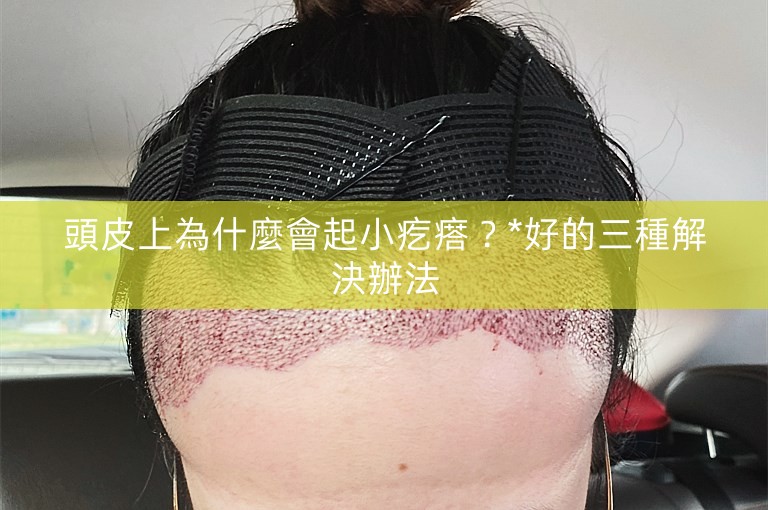 頭皮上為什麼會起小疙瘩?*好的三種解決辦法 頭皮上為什麼會起小疙瘩?*好的三種解決辦法