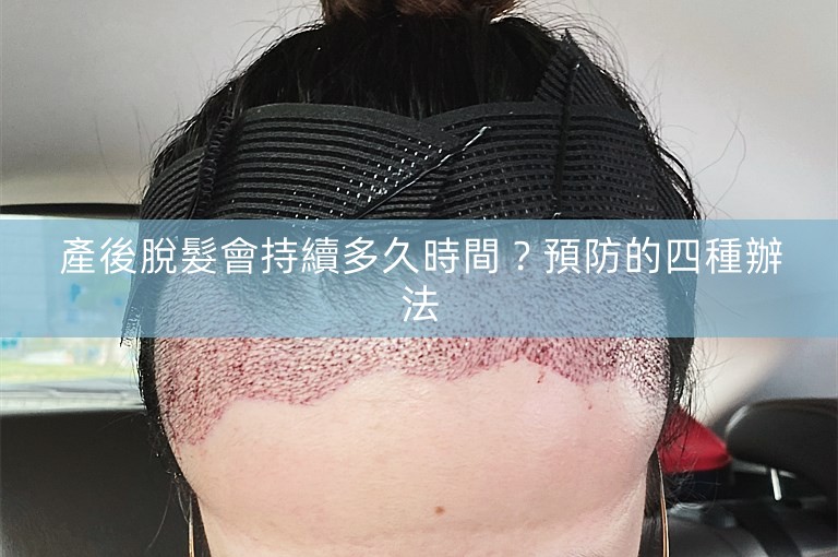 產後脫髮會持續多久時間？預防的四種辦法