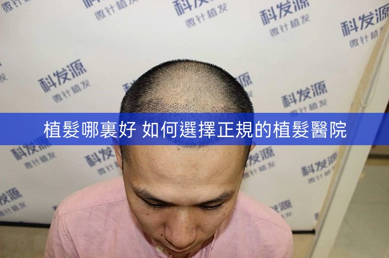植髮哪裏好 如何選擇正規的植髮醫院