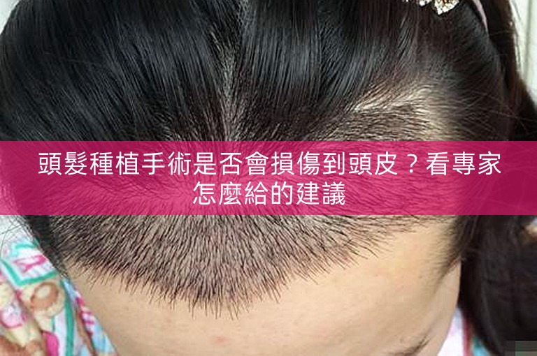 頭髮種植手術是否會損傷到頭皮？看專家怎麼給的建議