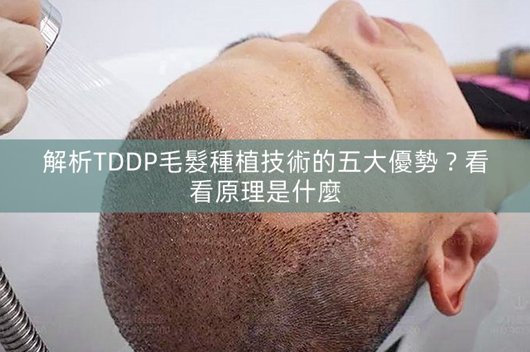 解析TDDP毛髮種植技術的五大優勢？看看原理是什麼