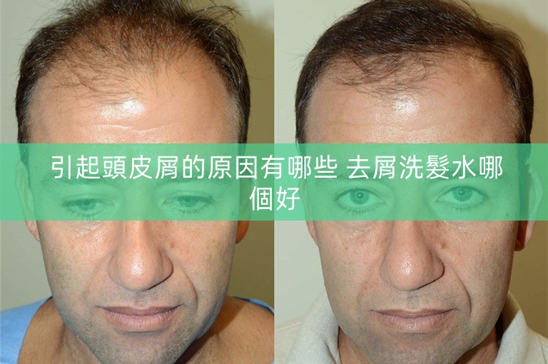 引起頭皮屑的原因有哪些 去屑洗髮水哪個好