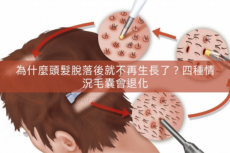 為什麼頭髮脫落後就不再生長了？四種情況毛囊會退化