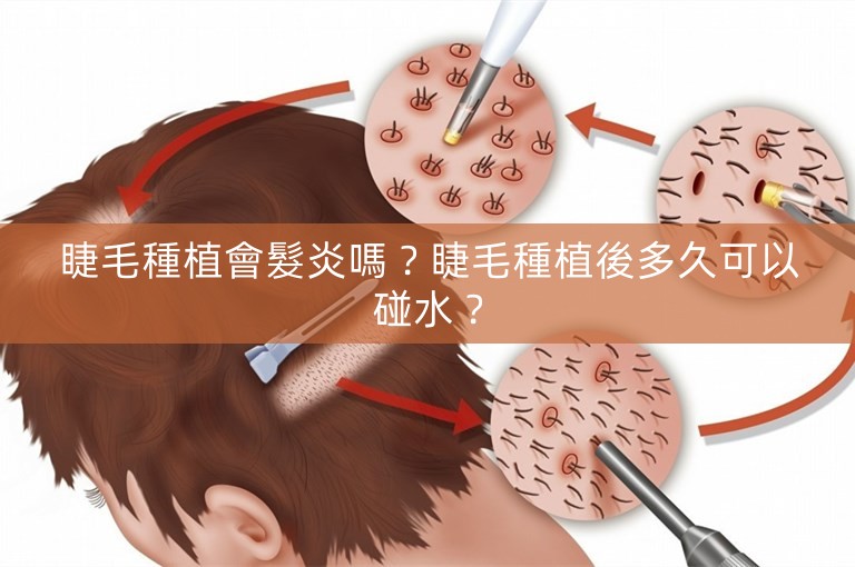 睫毛種植會髮炎嗎？睫毛種植後多久可以碰水？