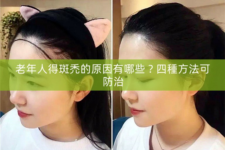 老年人得斑禿的原因有哪些？四種方法可防治