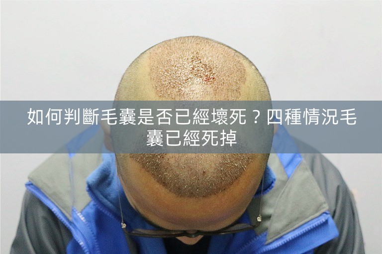如何判斷毛囊是否已經壞死？四種情況毛囊已經死掉